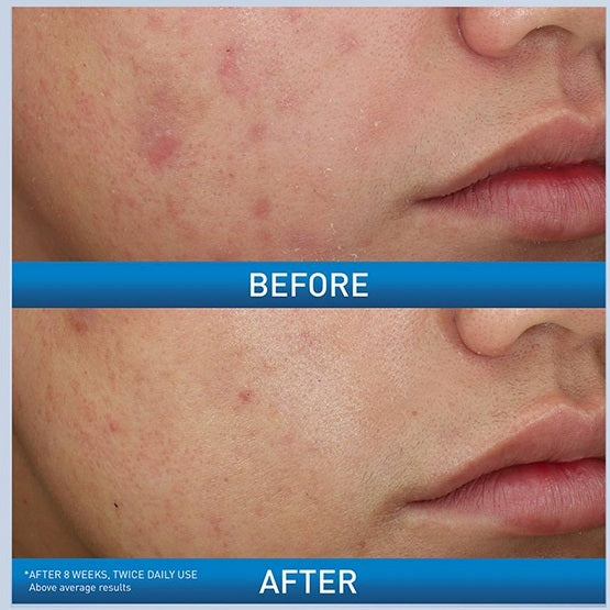 CERAVE Acne Foaming Cream Wash 150ML Price In Pakistan 